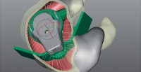 Phonak eshell Otoplastik